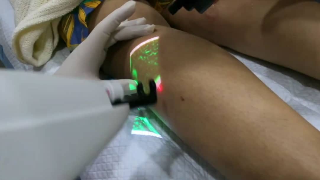 Varicose vein treatment in Singapore