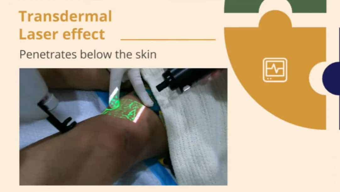 CLaCS treatment for spider veins