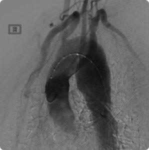 abdominal aortic aneurysm singapore