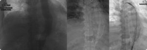 aortic aneurysm