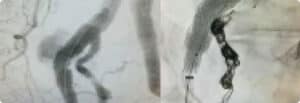 Brain-Aneurysm-img2