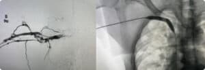 Deep-vein-thrombosis-img-1