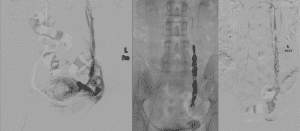 pelvic congestion syndrome