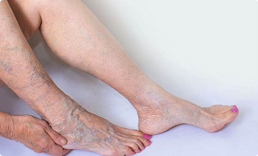 Varicose & Spider Veins