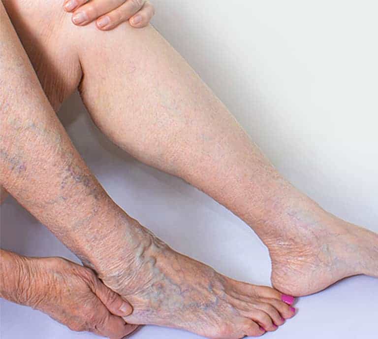 Varicose & Spider Veins