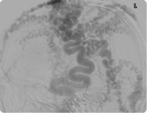 venous malformation brain treatment singapore