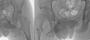 arteriovenous malformation s treatment singapore
