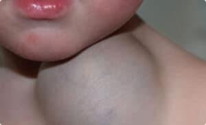 Vascular-Malformations