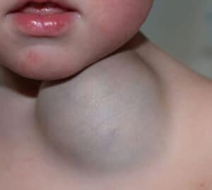 vascular malformation venous malformation brain treatment singapore arteriovenous malformation s treatment singapore